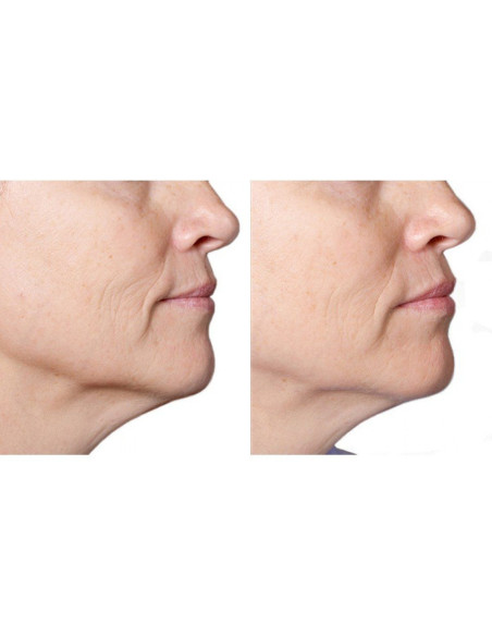 Aparat antirid Silkn FaceFX – tehnologie LED pentru îngrijirea tenului