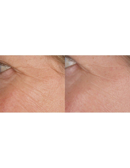 Aparat antirid Silkn FaceFX – tehnologie LED pentru îngrijirea tenului