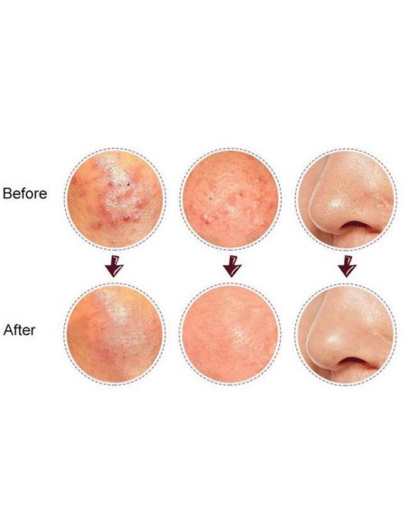 Extractor comedoane si cosuri