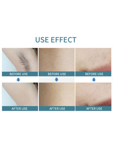 Aparat Epilare Definitiva cu Dioda Laser 808nm