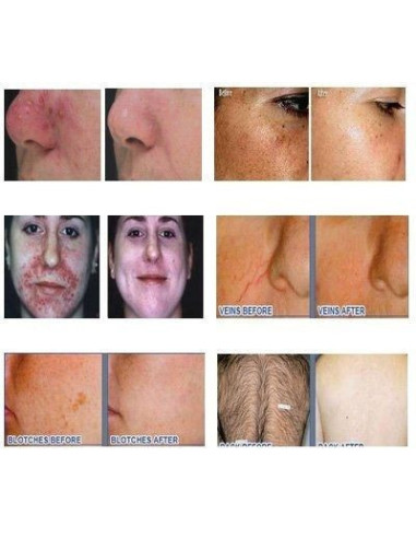 Epilator IPL profesional cu 3 filtre – epilare definitivă și rejuvenare