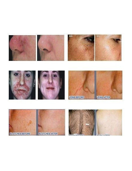 Epilator IPL profesional cu 3 filtre – epilare definitivă și rejuvenare